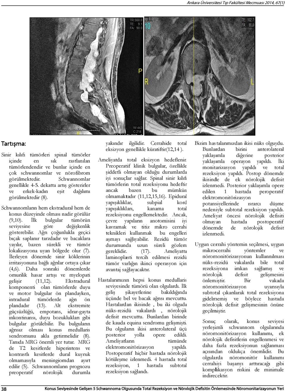 İlk bulgular tümörün seviyesine göre değişkenlik gösterebilir. Ağrı çoğunlukla geçici bıçak saplanır tarzdadır bacaklara yayılır, bazen sürekli tümör lokalizasyonaa uyan bölgede olur (7).