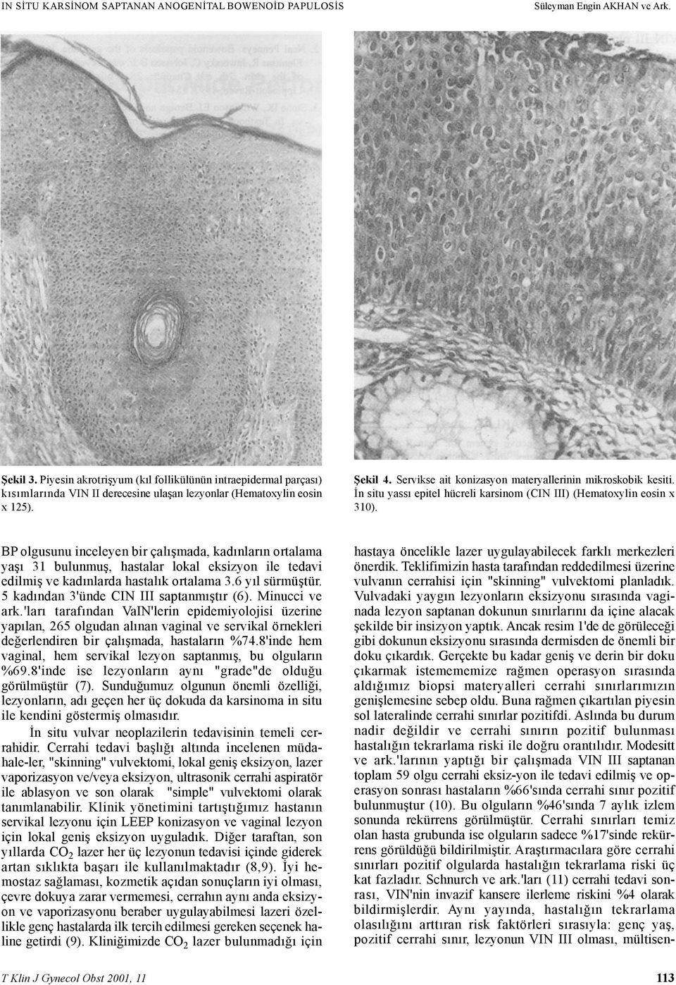 Servikse ait konizasyon materyallerinin mikroskobik kesiti. Ýn situ yassý epitel hücreli karsinom (CIN III) (Hematoxylin eosin x 310).