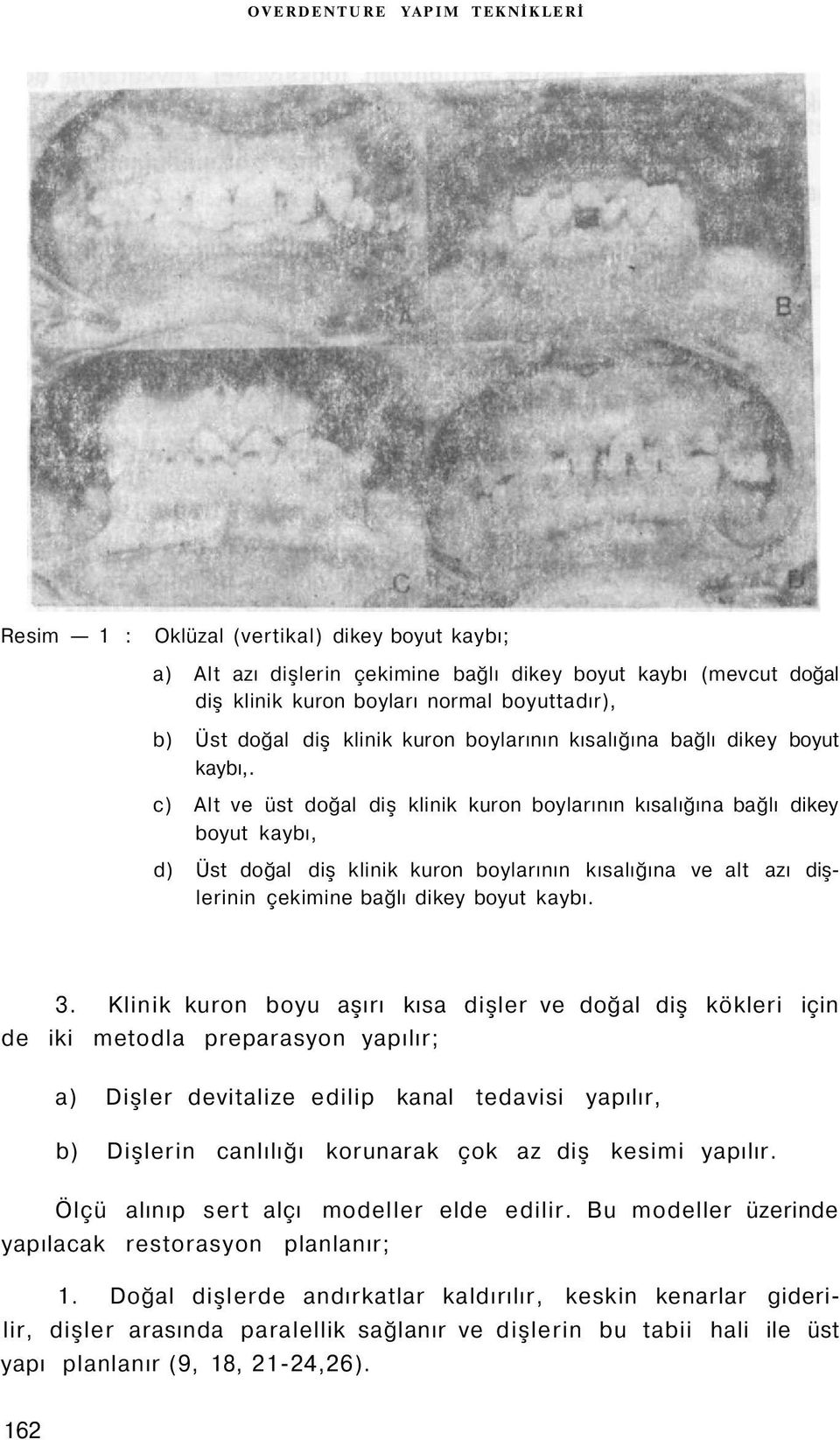 c) Alt ve üst doğal diş klinik kuron boylarının kısalığına bağlı dikey boyut kaybı, d) Üst doğal diş klinik kuron boylarının kısalığına ve alt azı dişlerinin çekimine bağlı dikey boyut kaybı. 3.