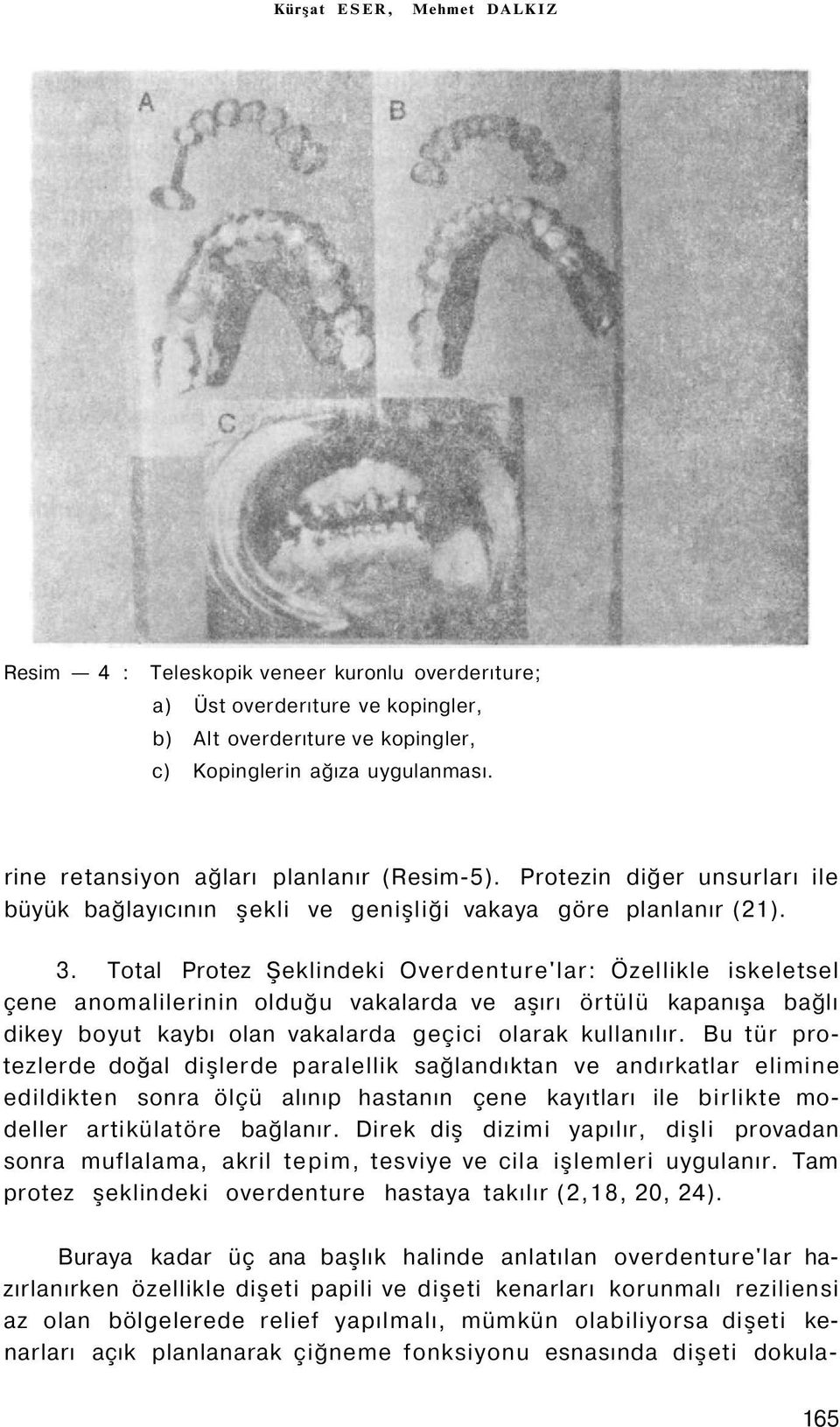 Total Protez Şeklindeki Overdenture'lar: Özellikle iskeletsel çene anomalilerinin olduğu vakalarda ve aşırı örtülü kapanışa bağlı dikey boyut kaybı olan vakalarda geçici olarak kullanılır.