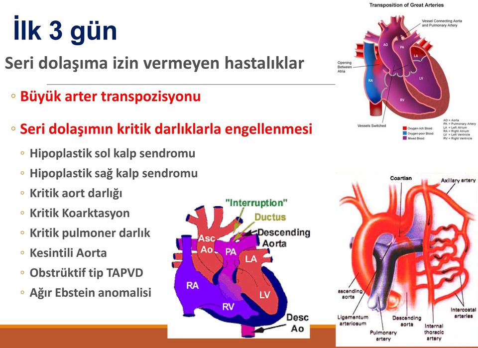 Hipoplastik sağ kalp sendromu Kritik aort darlığı Kritik Koarktasyon Kritik