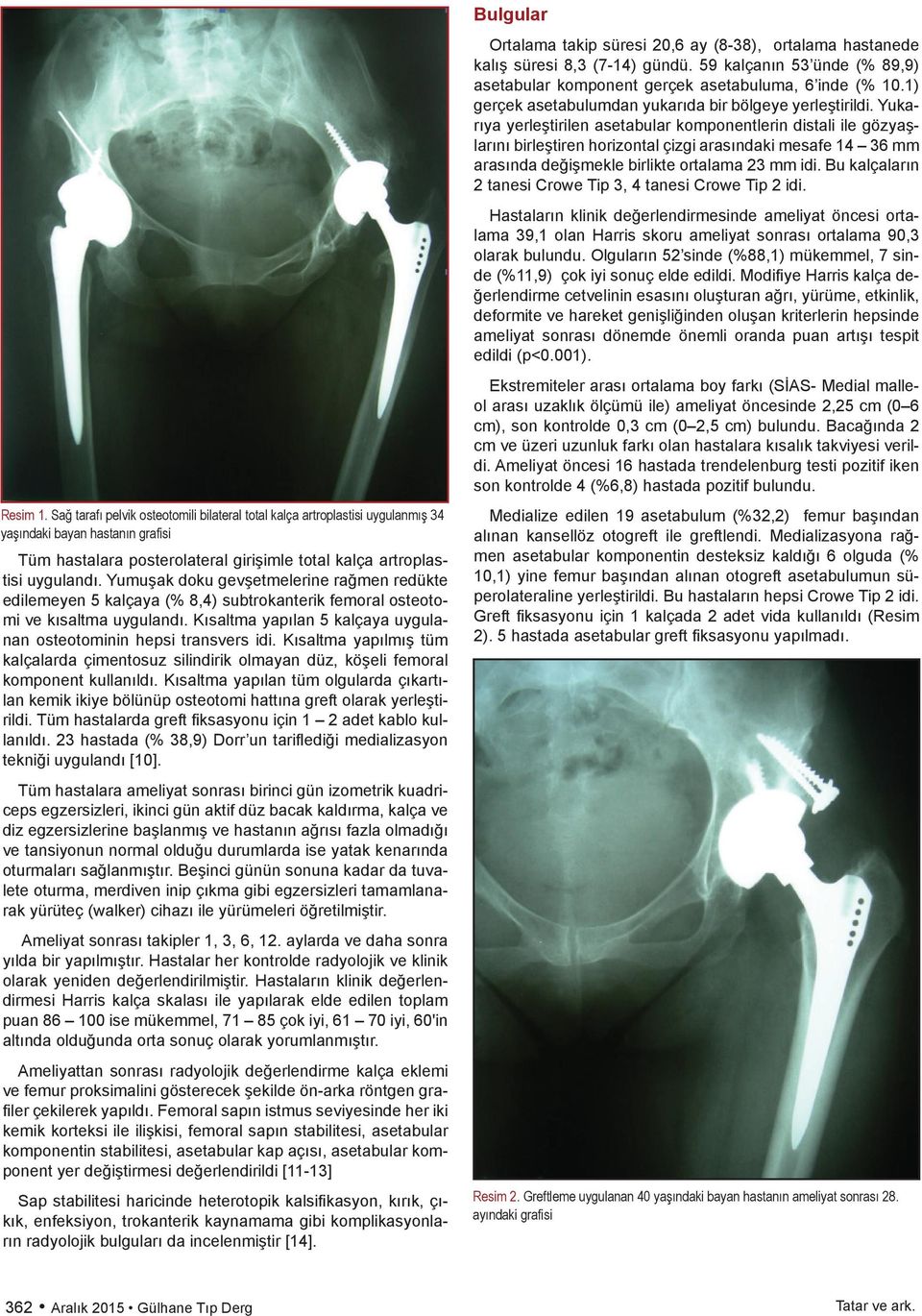 Kısaltma yapılmış tüm kalçalarda çimentosuz silindirik olmayan düz, köşeli femoral komponent kullanıldı.