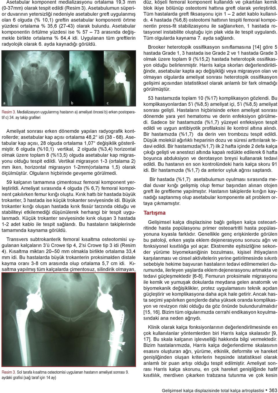 Asetabular komponentin örtülme yüzdesi ise % 57 73 arasında değişmekle birlikte ortalama % 64,4 idi. Uygulanan tüm greftlerin radyolojik olarak 6. ayda kaynadığı görüldü. Resim 3.