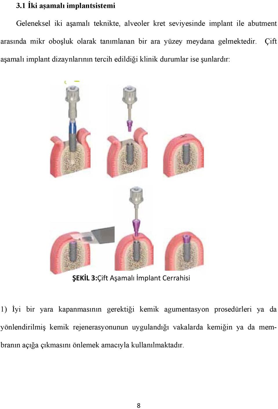 Çift aşamalı implant dizaynlarının tercih edildiği klinik durumlar ise şunlardır: ŞEKİL 3:Çift Aşamalı İmplant Cerrahisi 1) İyi