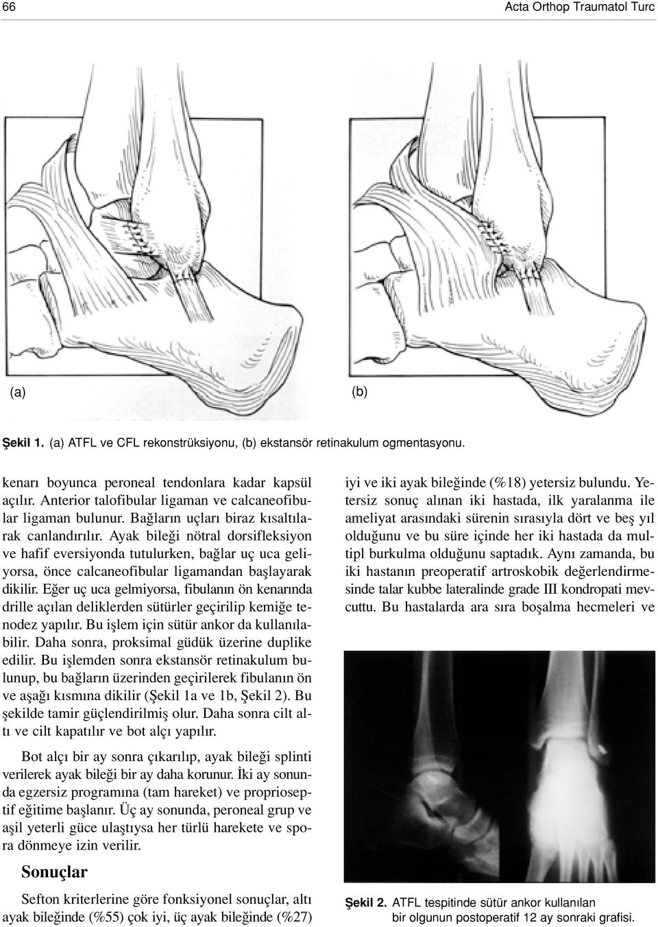 Ayak bile i nötral dorsifleksiyon ve hafif eversiyonda tutulurken, ba lar uç uca geliyorsa, önce calcaneofibular ligamandan bafllayarak dikilir.