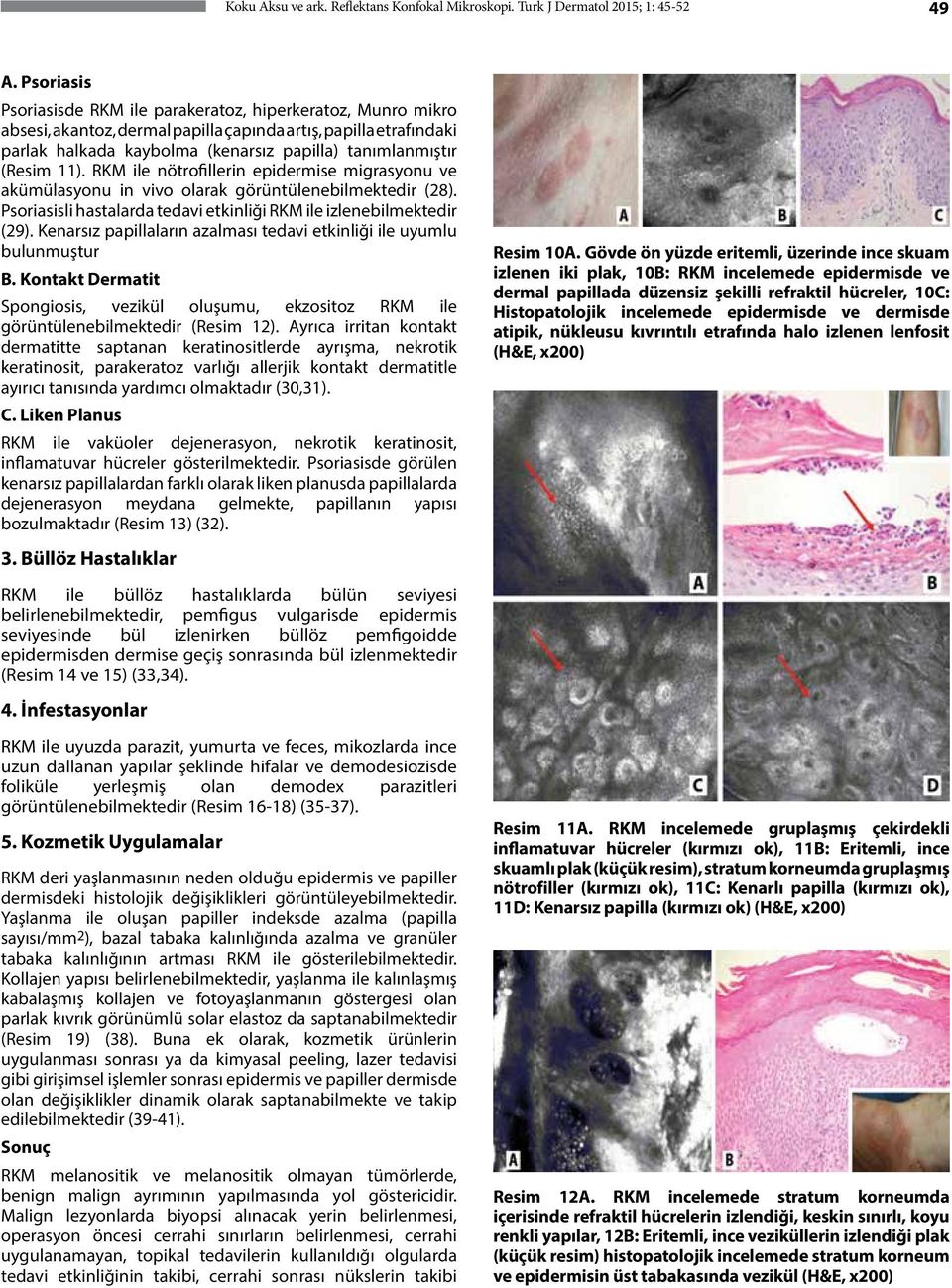 (Resim 11). RKM ile nötrofillerin epidermise migrasyonu ve akümülasyonu in vivo olarak görüntülenebilmektedir (28). Psoriasisli hastalarda tedavi etkinliği RKM ile izlenebilmektedir (29).