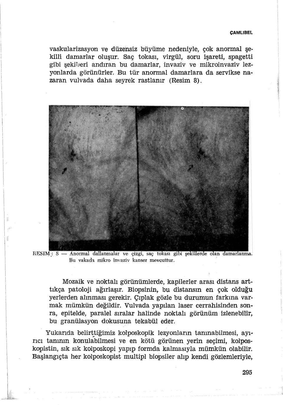 . zaran vulvada daha seyrek rastlanır (Resim 8). HE.SİM : 8 - Anormal dallanmalar ve çizgi, saç tokası gibi şekillerde olan damarlanma. Bu vakada mikro invaziv kanser ~ejvouttur.