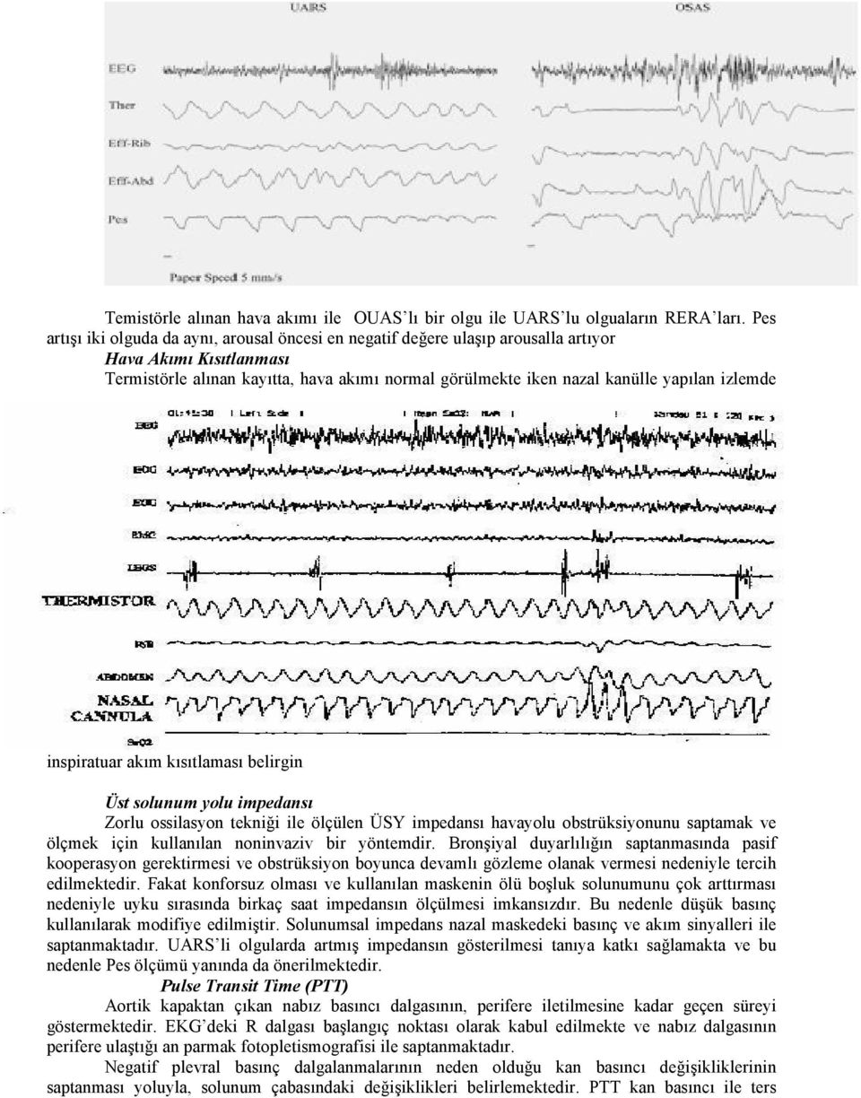 izlemde inspiratuar akım kısıtlaması belirgin Üst solunum yolu impedansı Zorlu ossilasyon tekniği ile ölçülen ÜSY impedansı havayolu obstrüksiyonunu saptamak ve ölçmek için kullanılan noninvaziv bir