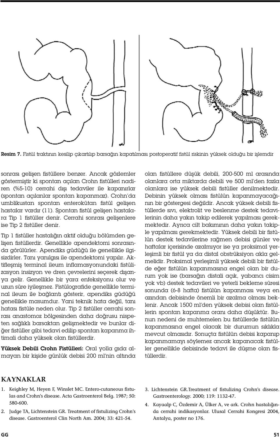 Crohn da umblikustan spontan enterokütan fistül geli en hastalar vardır ( ). Spontan fistül geli en hastalara Tip fistüller denir. Cerrahi sonrası geli enlere ise Tip 2 fistüller denir.