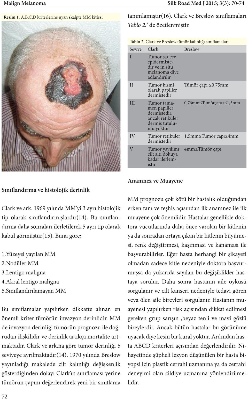 Clark ve Breslow tümör kalınlığı sınıflamaları Seviye Clark Breslow I II III IV V Tümör sadece epidermistedir ve in situ melanoma diye adlandırılır Tümör kısmi olarak papiller dermistedir Tümör