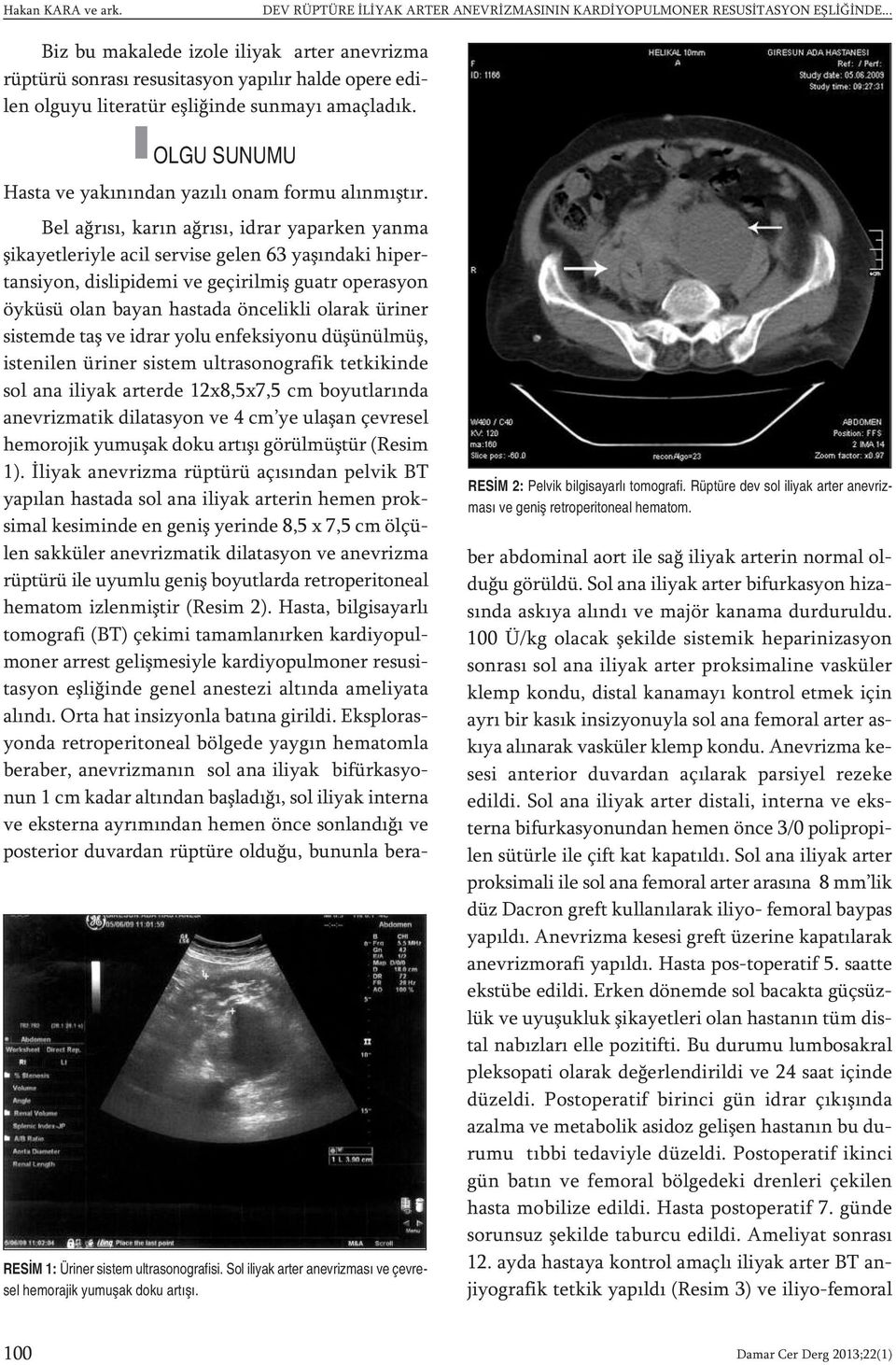 OLGU SUNUMU RESİM 1: Üriner sistem ultrasonografisi. Sol iliyak arter anevrizması ve çevresel hemorajik yumuşak doku artışı. RESİM 2: Pelvik bilgisayarlı tomografi.