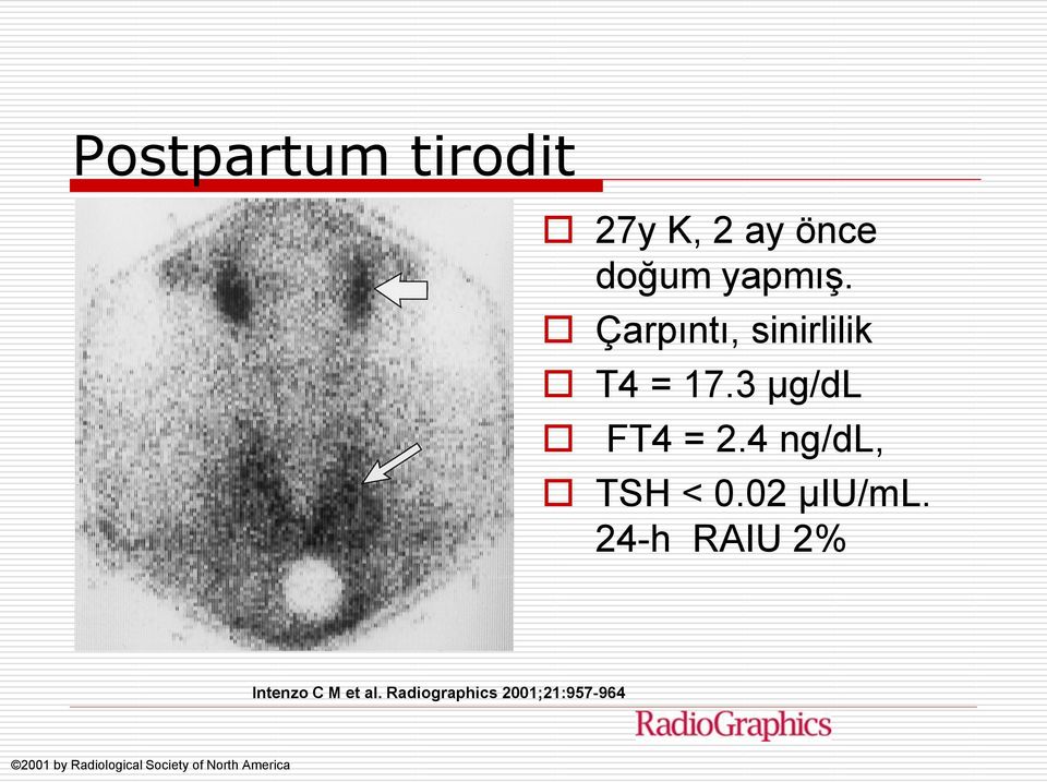 4 ng/dl, TSH < 0.02 μiu/ml.