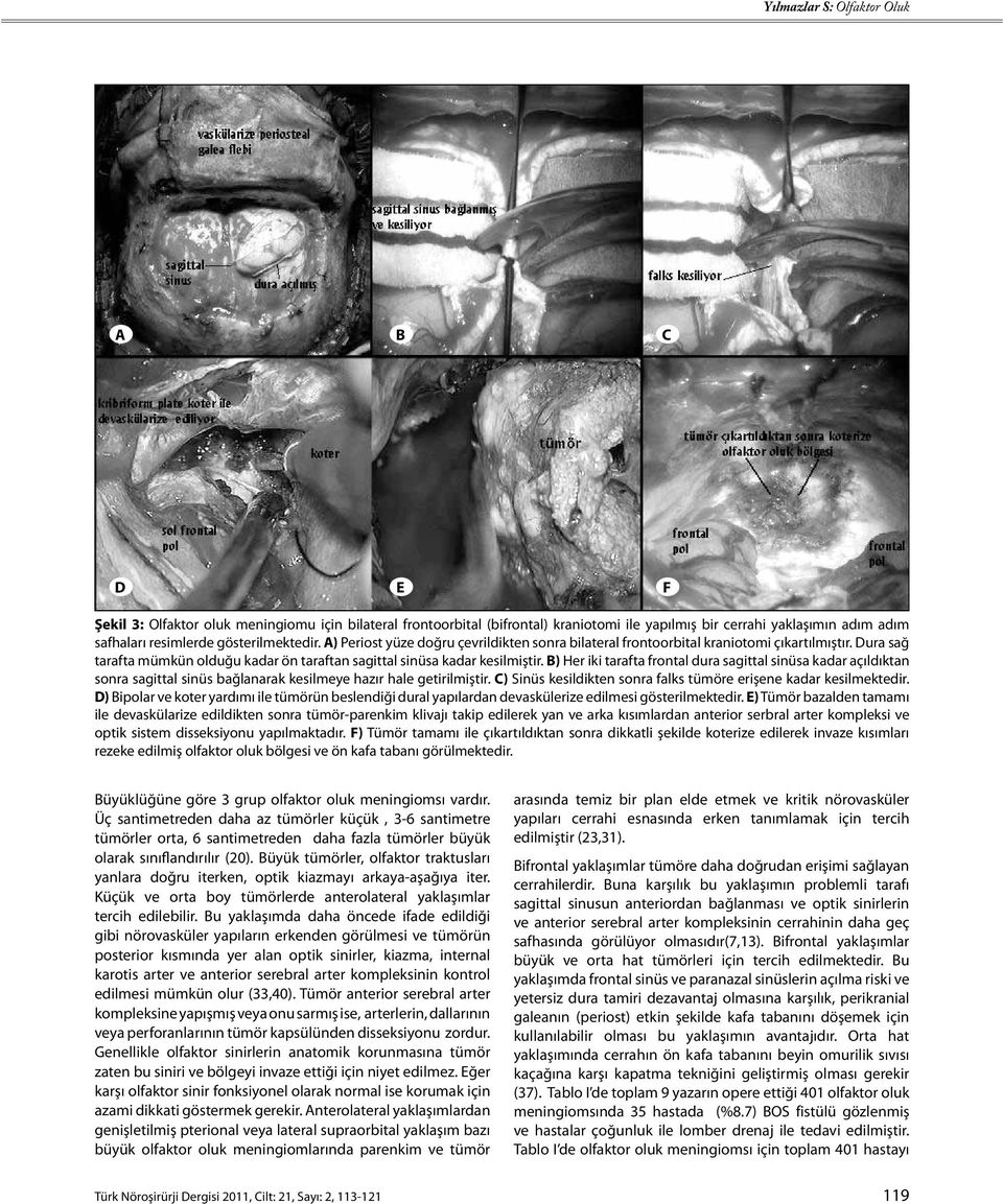 B) Her iki tarafta frontal dura sagittal sinüsa kadar açıldıktan sonra sagittal sinüs bağlanarak kesilmeye hazır hale getirilmiştir.