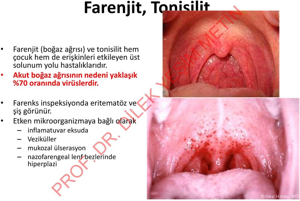 Farenks inspeksiyonda eritematöz ve şiş görünür.