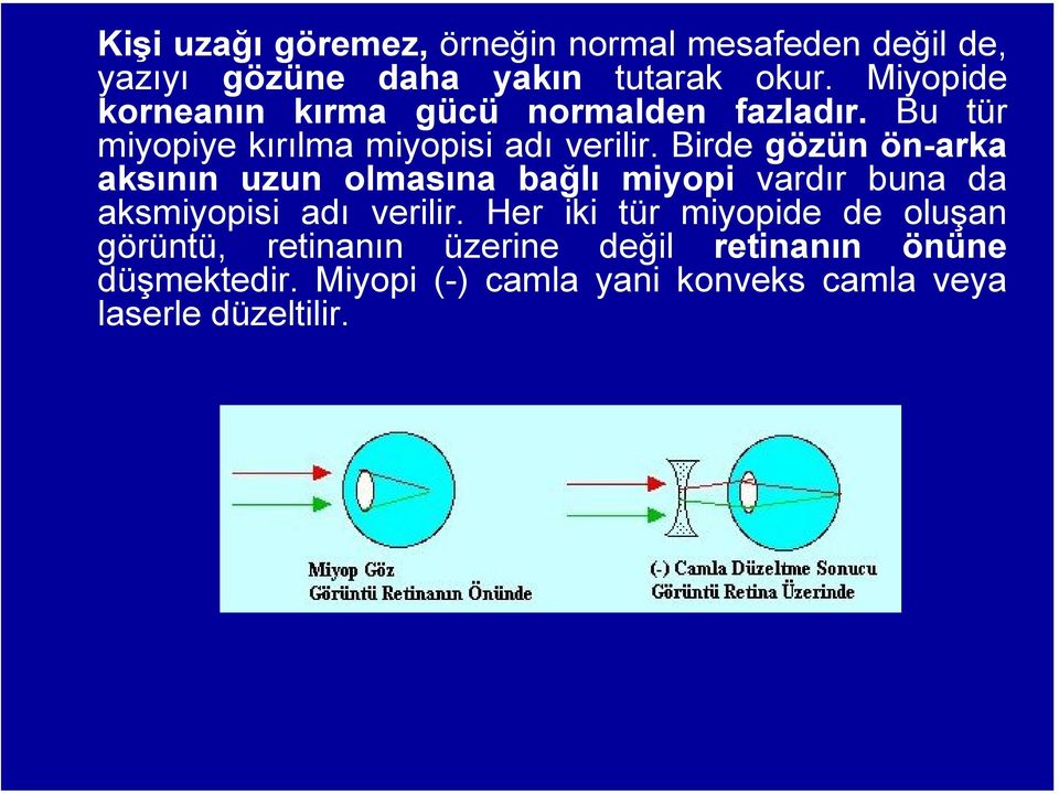 Birde gözün ön-arka aksının uzun olmasına bağlı miyopi vardır buna da aksmiyopisi adı verilir.