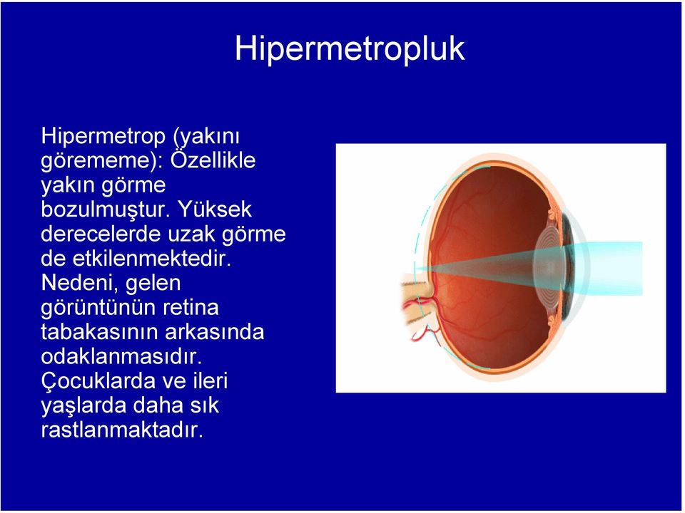 Nedeni, gelen görüntünün retina tabakasının arkasında