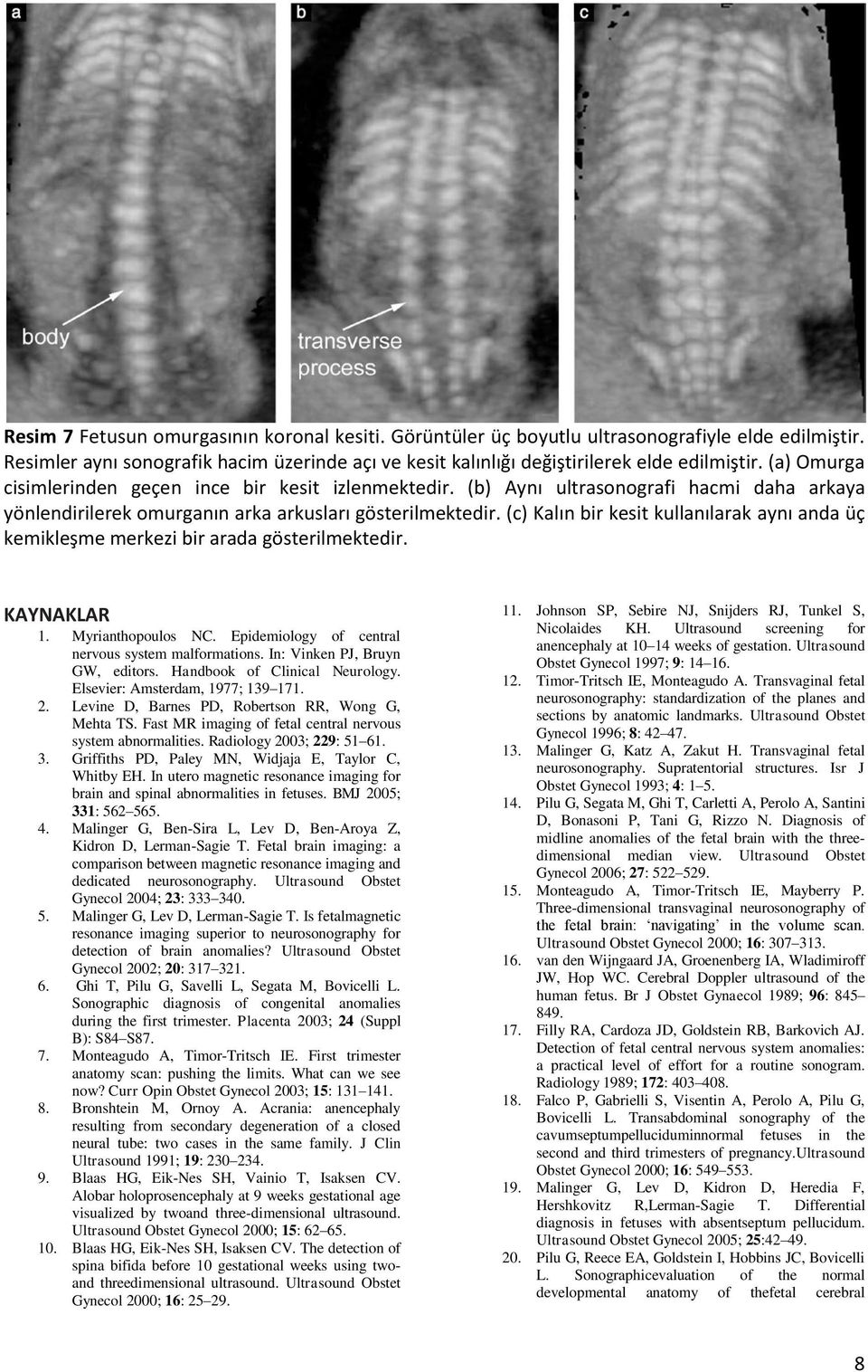 (c) Kalın bir kesit kullanılarak aynı anda üç kemikleşme merkezi bir arada gösterilmektedir. KAYNAKLAR 1. Myrianthopoulos NC. Epidemiology of central nervous system malformations.