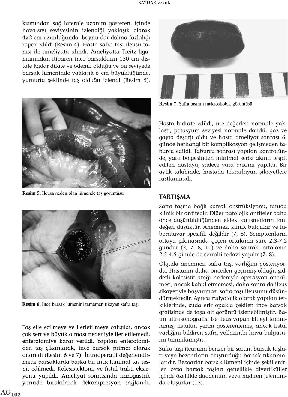 Ameliyatta Treitz ligamanından itibaren ince barsakların 150 cm distale kadar dilate ve ödemli olduğu ve bu seviyede barsak lümeninde yaklaşık 6 cm büyüklüğünde, yumurta şeklinde taş olduğu izlendi