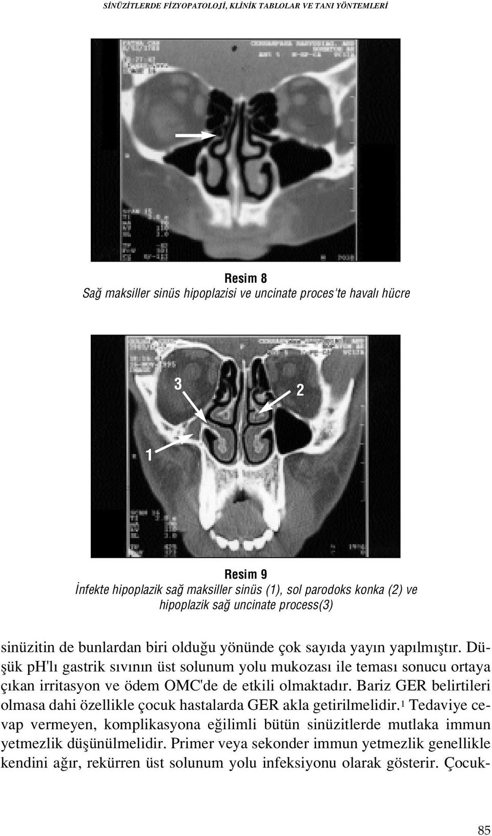 Düflük ph'l gastrik s v n n üst solunum yolu mukozas ile temas sonucu ortaya ç kan irritasyon ve ödem OMC'de de etkili olmaktad r.