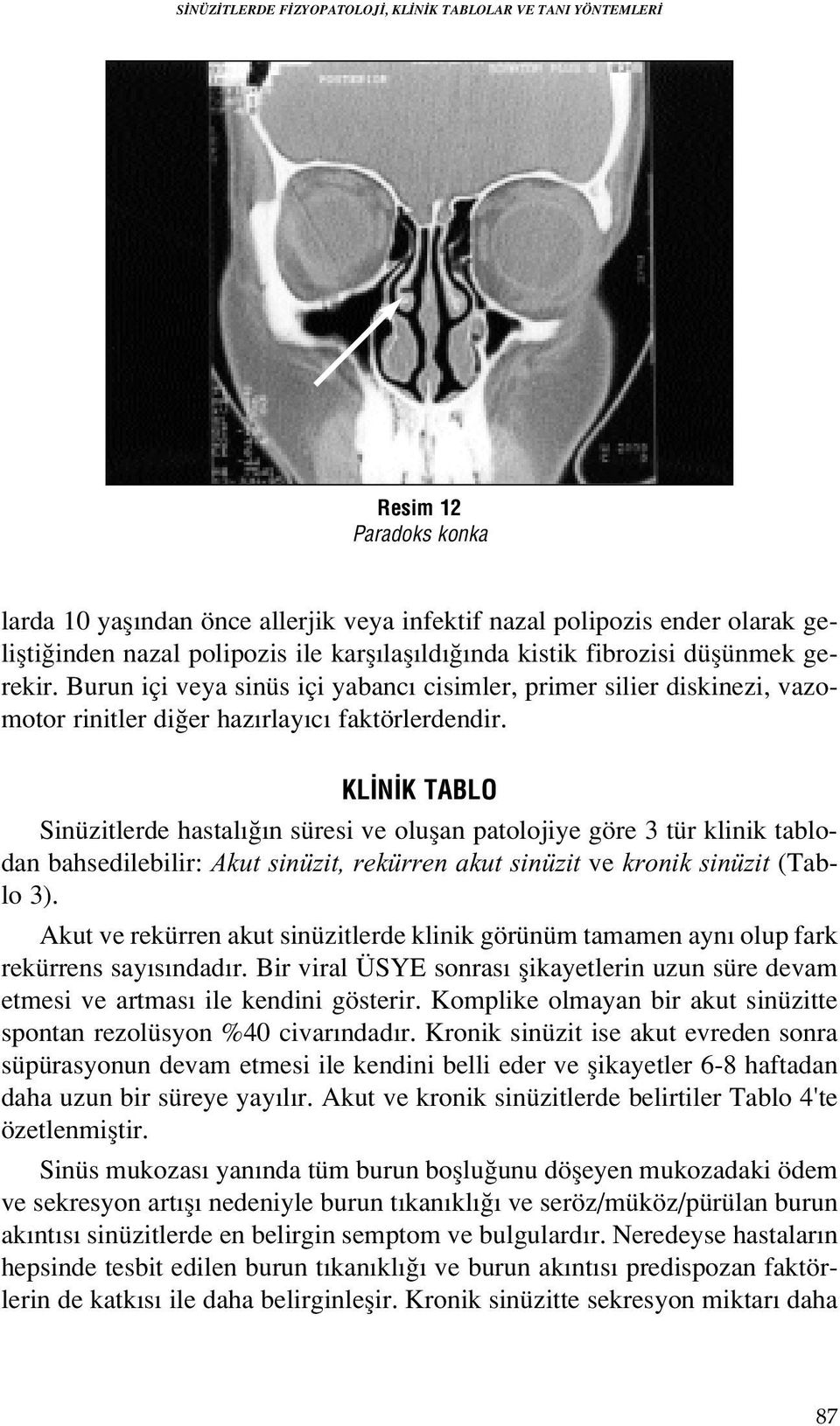 KL N K TABLO Sinüzitlerde hastal n süresi ve oluflan patolojiye göre 3 tür klinik tablodan bahsedilebilir: Akut sinüzit, rekürren akut sinüzit ve kronik sinüzit (Tablo 3).