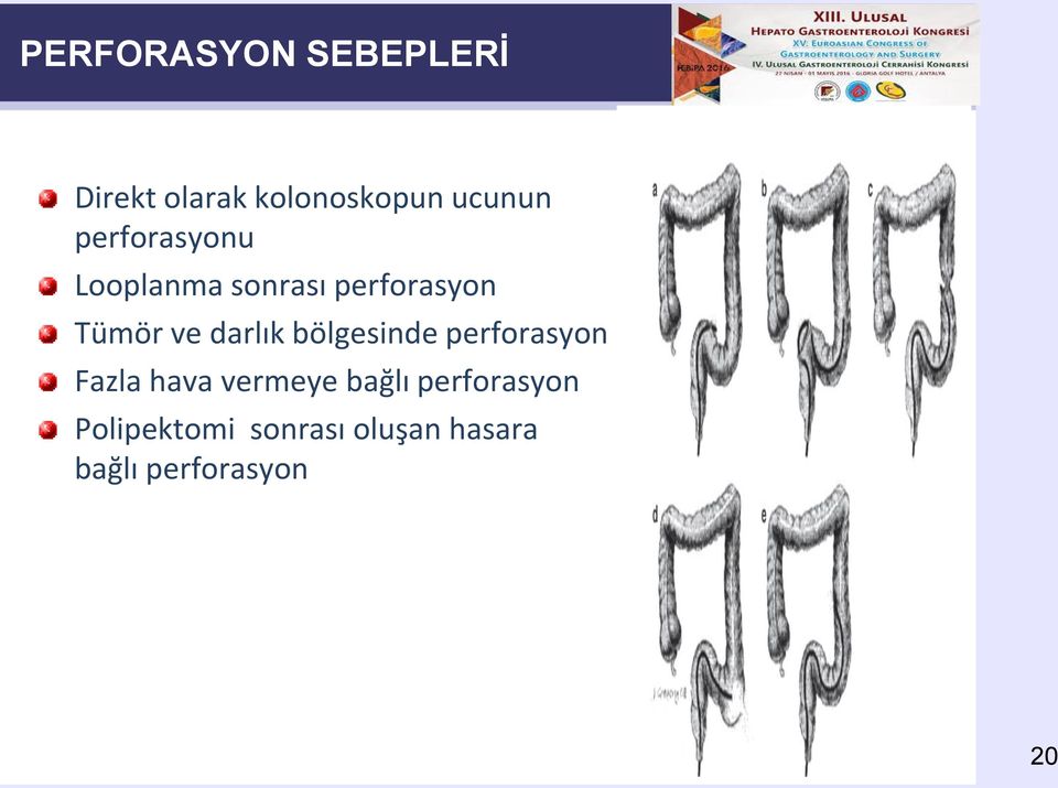 darlık bölgesinde perforasyon Fazla hava vermeye bağlı