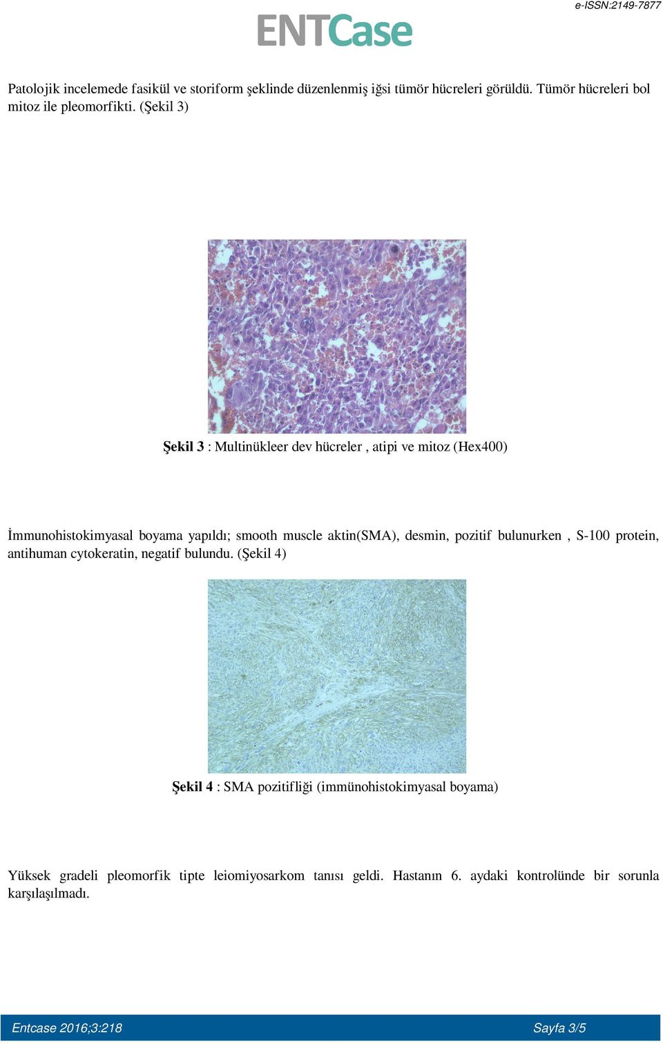 desmin, pozitif bulunurken, S-100 protein, antihuman cytokeratin, negatif bulundu.