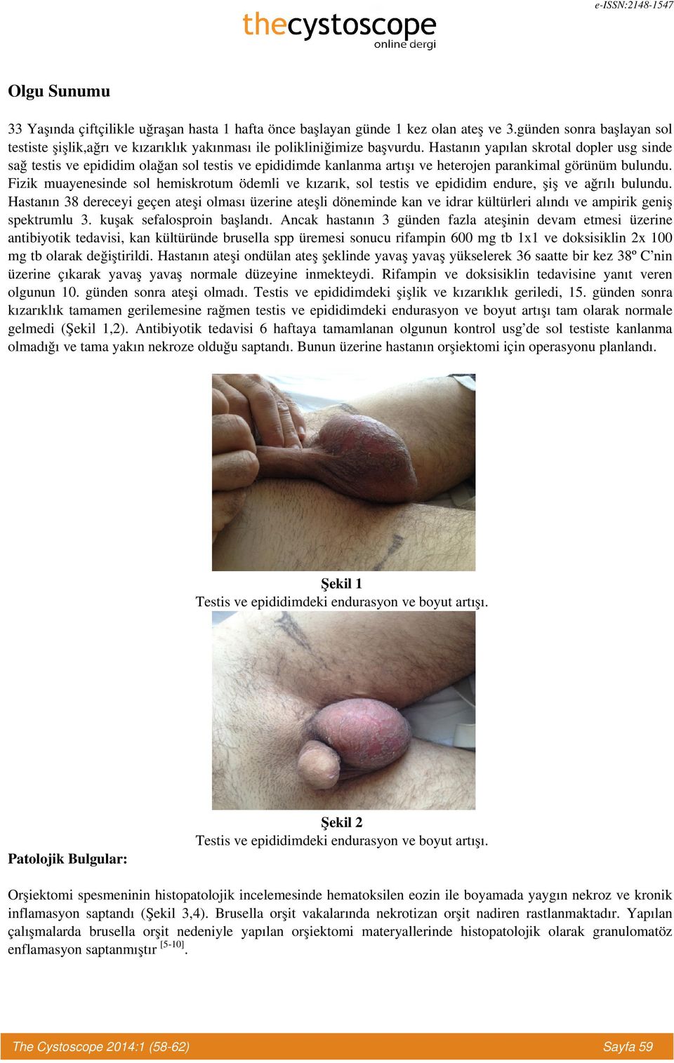 Fizik muayenesinde sol hemiskrotum ödemli ve kızarık, sol testis ve epididim endure, şiş ve ağrılı bulundu.