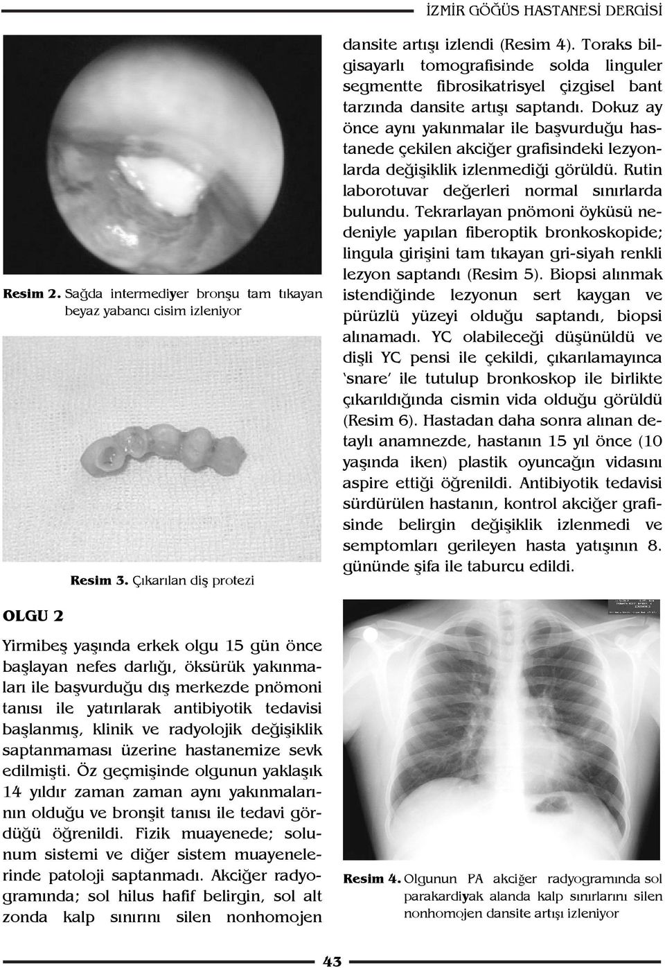 Dokuz ay önce aynı yakınmalar ile başvurduğu hastanede çekilen akciğer grafisindeki lezyonlarda değişiklik izlenmediği görüldü. Rutin laborotuvar değerleri normal sınırlarda bulundu.