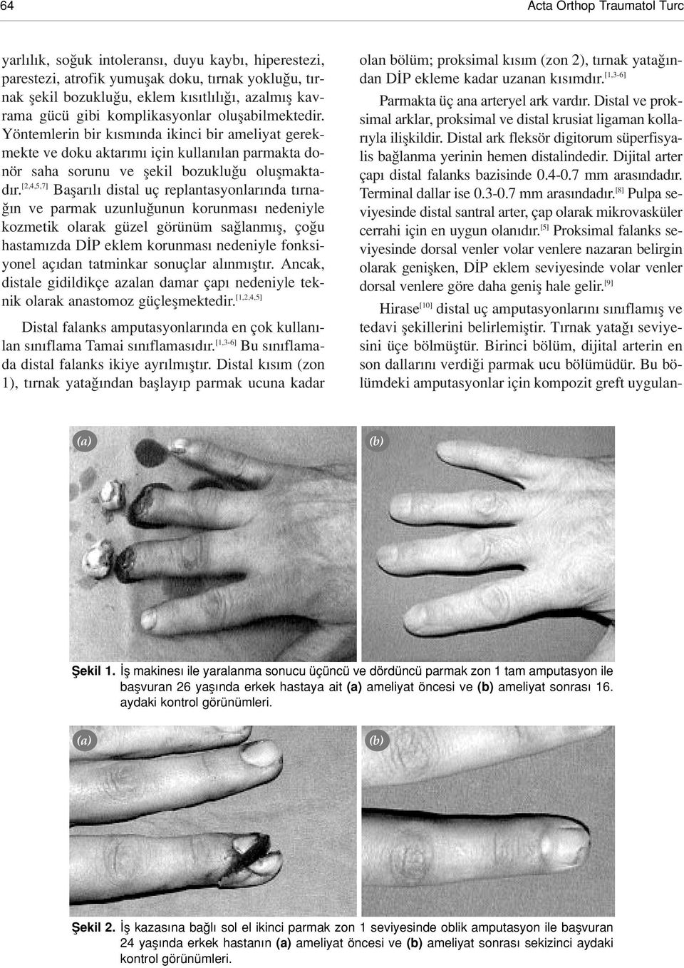 [2,4,5,7] Baflar l distal uç replantasyonlar nda t rna- n ve parmak uzunlu unun korunmas nedeniyle kozmetik olarak güzel görünüm sa lanm fl, ço u hastam zda D P eklem korunmas nedeniyle fonksiyonel