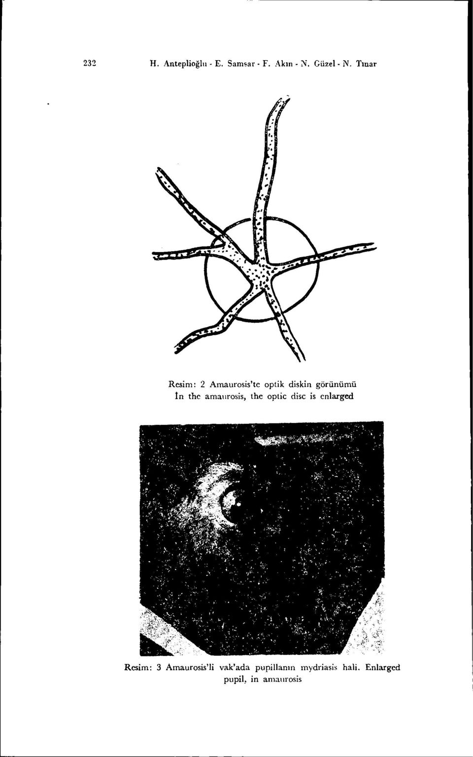 amallrasis, the optic disc is enlarged Resim: 3