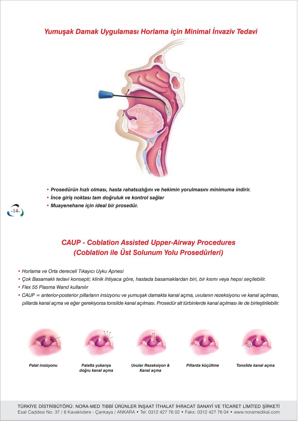 CAUP - Coblation Assisted Upper-Airway Procedures (Coblation ile Üst Solunum Yolu Prosedürleri) Horlama ve Orta dereceli Týkayýcý Uyku Apnesi Çok Basamaklý tedavi konsepti; klinik ihtiyaca göre,