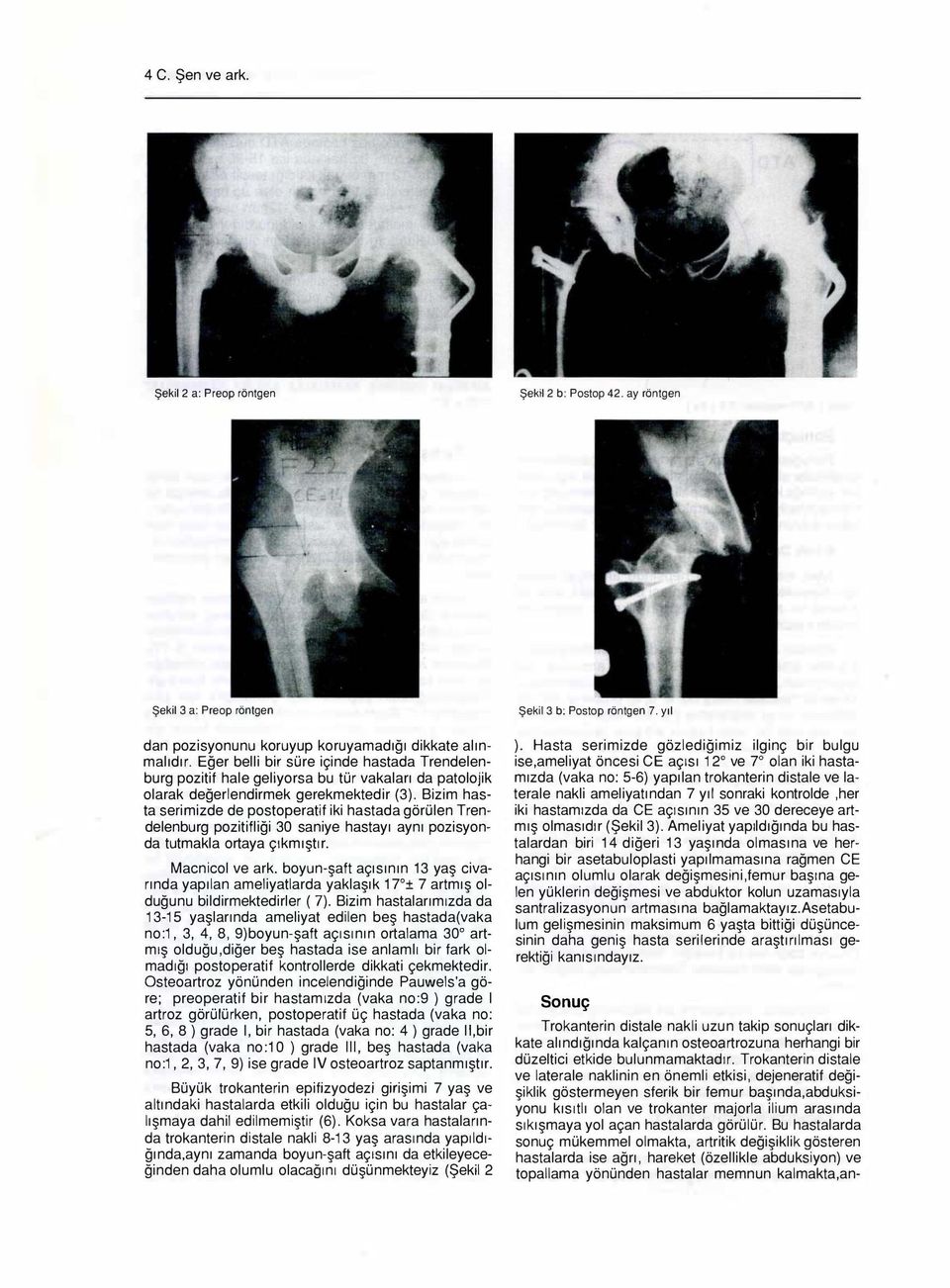 Bizim hasta serimizde de postoperatif iki hastada görülen Trendelenburg pozitifliği 30 saniye hastayı aynı pozisyonda tutmakla ortaya çıkmıştır. Macnicol ve ark.