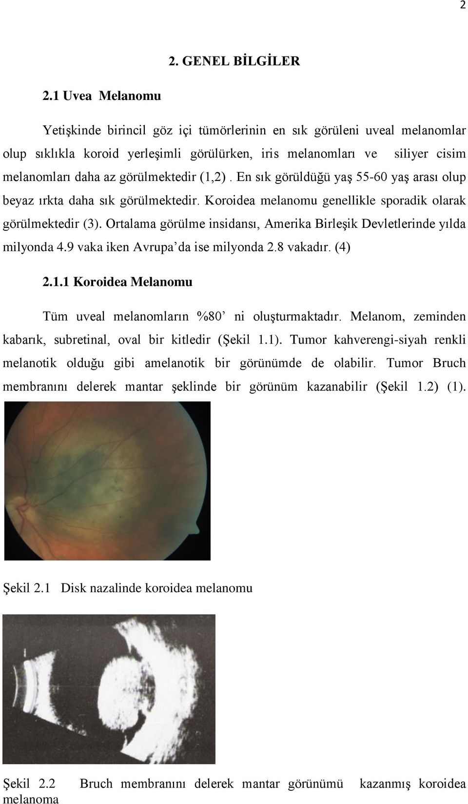 görülmektedir (1,2). En sık görüldüğü yaş 55-60 yaş arası olup beyaz ırkta daha sık görülmektedir. Koroidea melanomu genellikle sporadik olarak görülmektedir (3).