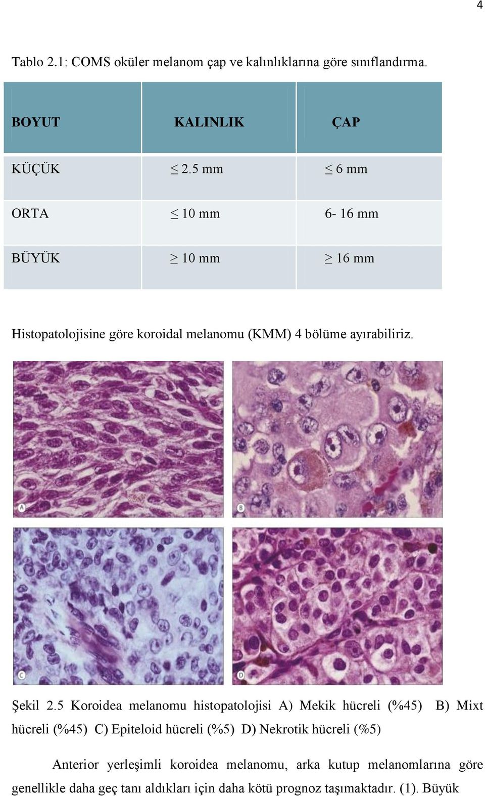 5 Koroidea melanomu histopatolojisi A) Mekik hücreli (%45) B) Mixt hücreli (%45) C) Epiteloid hücreli (%5) D) Nekrotik hücreli