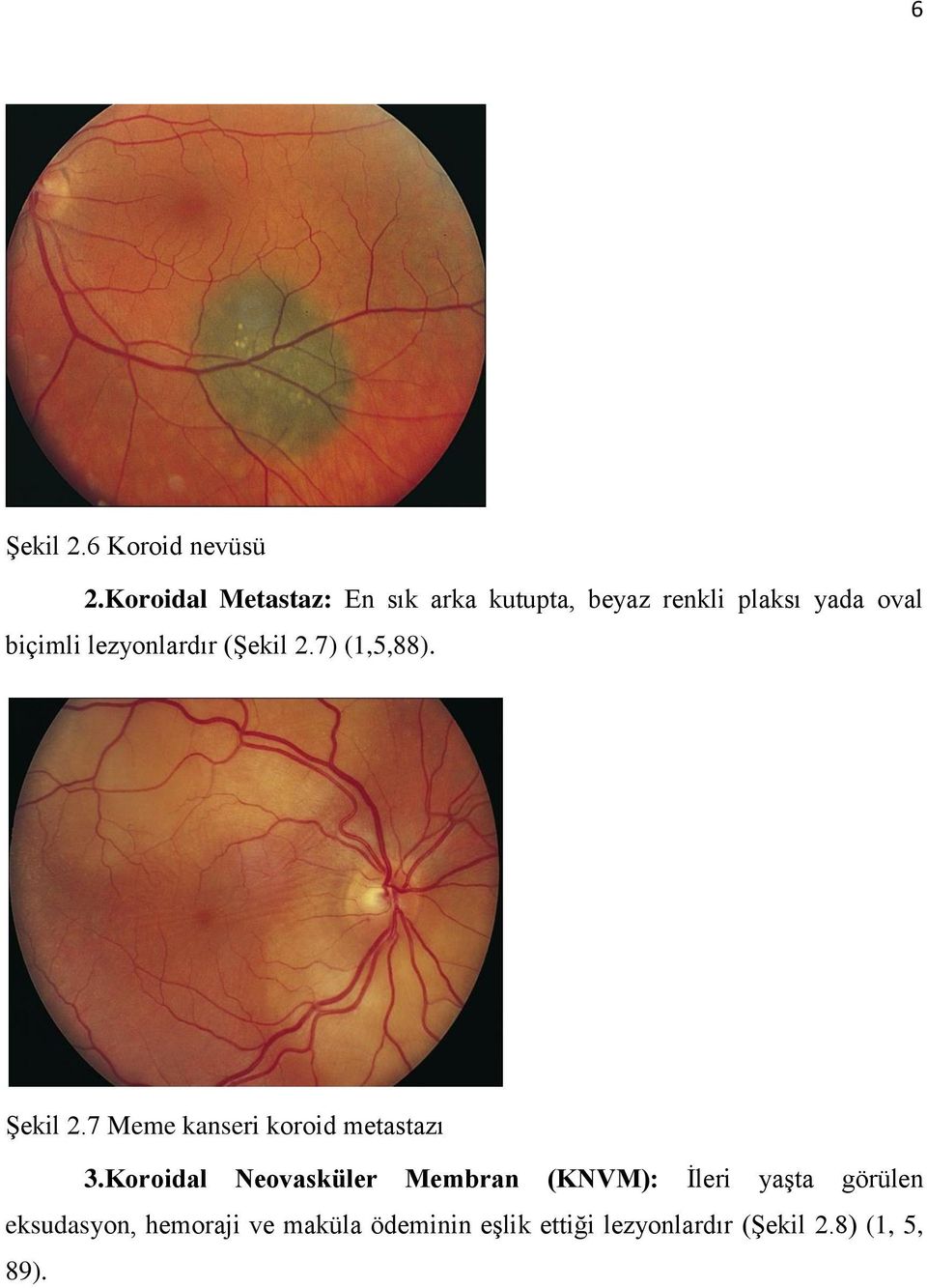 lezyonlardır (Şekil 2.7) (1,5,88). Şekil 2.7 Meme kanseri koroid metastazı 3.