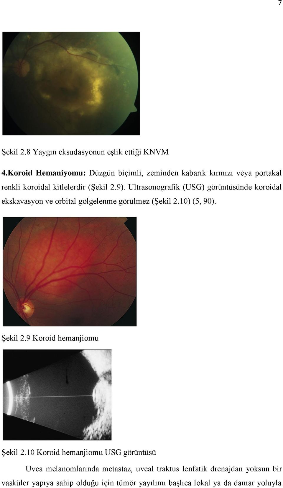 Ultrasonografik (USG) görüntüsünde koroidal ekskavasyon ve orbital gölgelenme görülmez (Şekil 2.10) (5, 90). Şekil 2.