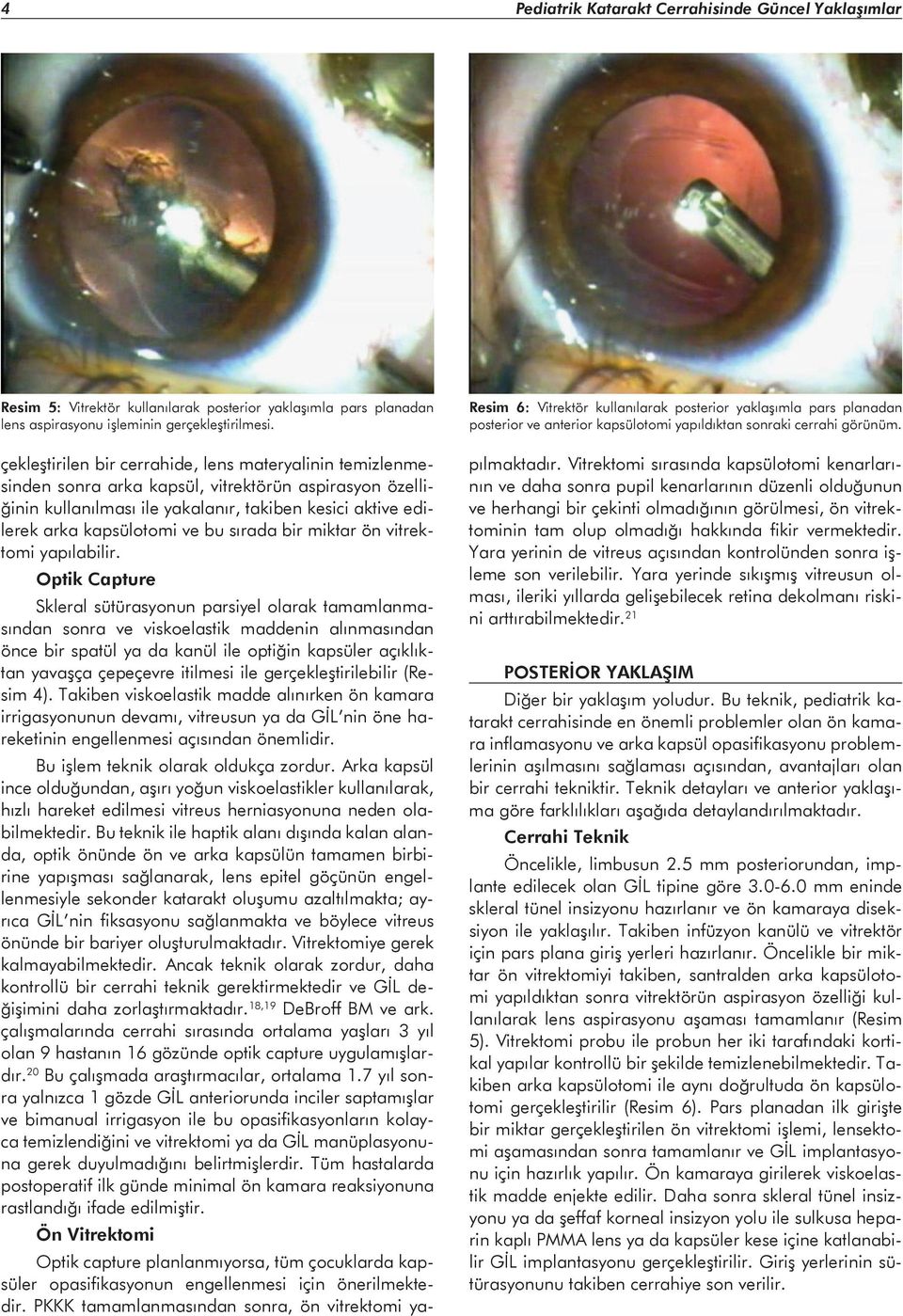 sırada bir miktar ön vitrektomi yapılabilir. Resim 6: Vitrektör kullanılarak posterior yaklaşımla pars planadan posterior ve anterior kapsülotomi yapıldıktan sonraki cerrahi görünüm.