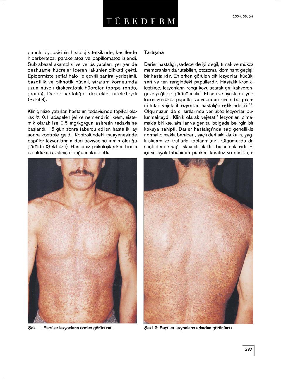 Epidermiste fleffaf halo ile çevrili santral yerleflimli, bazofilik ve piknotik nüveli, stratum korneumda uzun nüveli diskeratotik hücreler (corps ronds, grains), Darier hastal n destekler