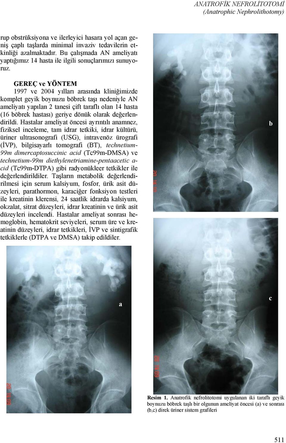 GEREÇ ve YÖNTEM 1997 ve 2004 yılları arasında kliniğimizde komplet geyik boynuzu böbrek taşı nedeniyle AN ameliyatı yapılan 2 tanesi çift taraflı olan 14 hasta (16 böbrek hastası) geriye dönük olarak