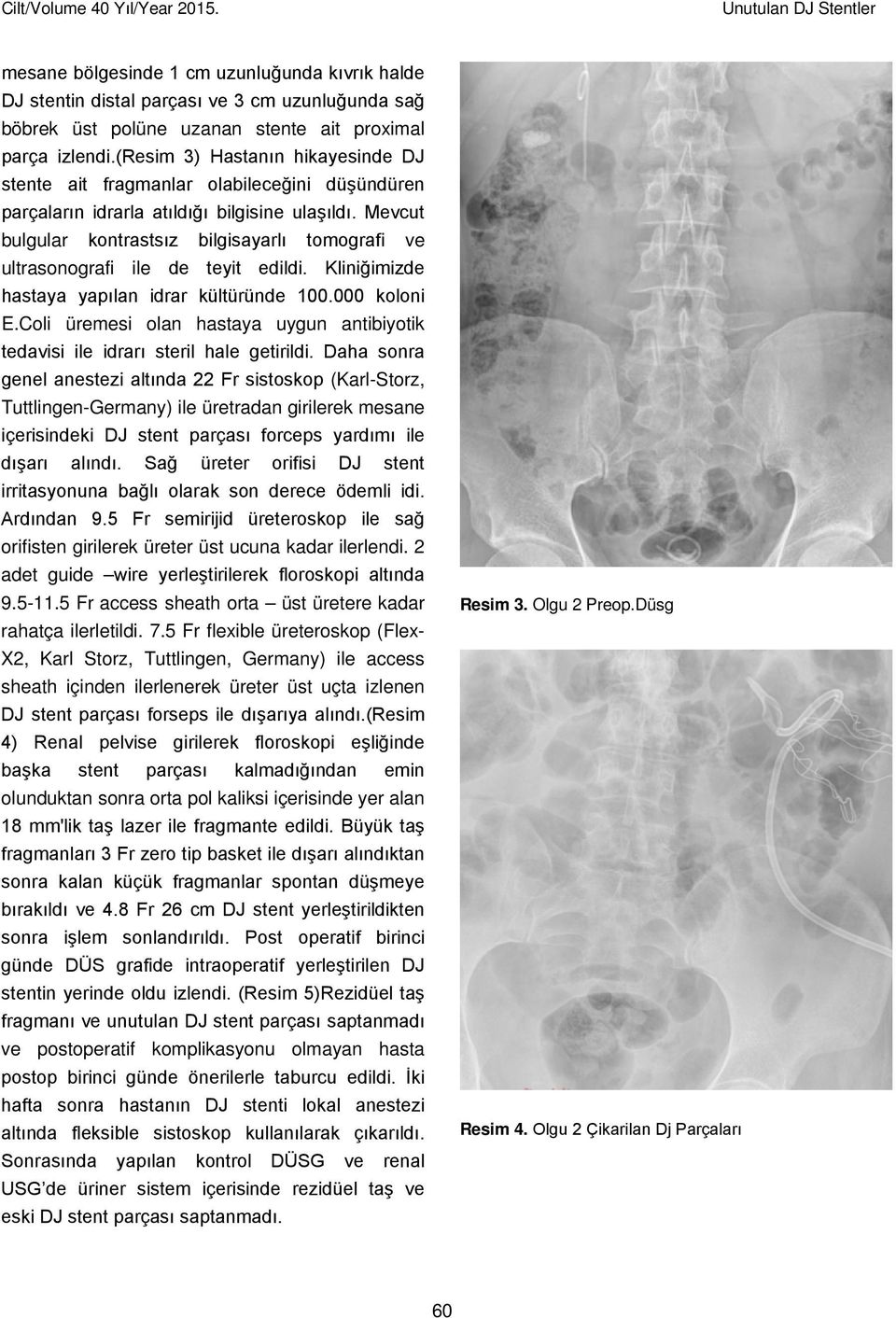 (resim 3) Hastanın hikayesinde DJ stente ait fragmanlar olabileceğini düşündüren parçaların idrarla atıldığı bilgisine ulaşıldı.