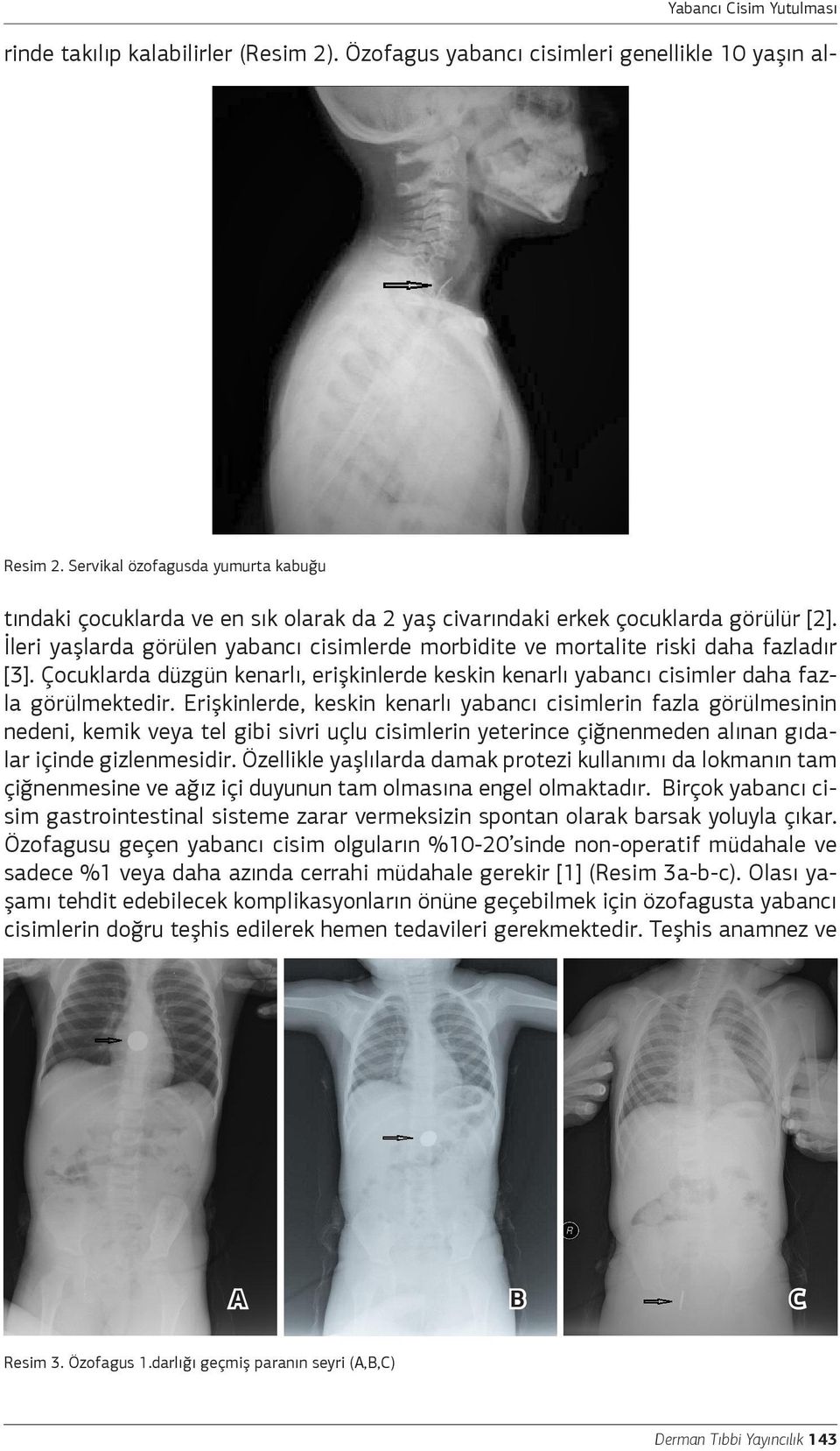 İleri yaşlarda görülen yabancı cisimlerde morbidite ve mortalite riski daha fazladır [3]. Çocuklarda düzgün kenarlı, erişkinlerde keskin kenarlı yabancı cisimler daha fazla görülmektedir.