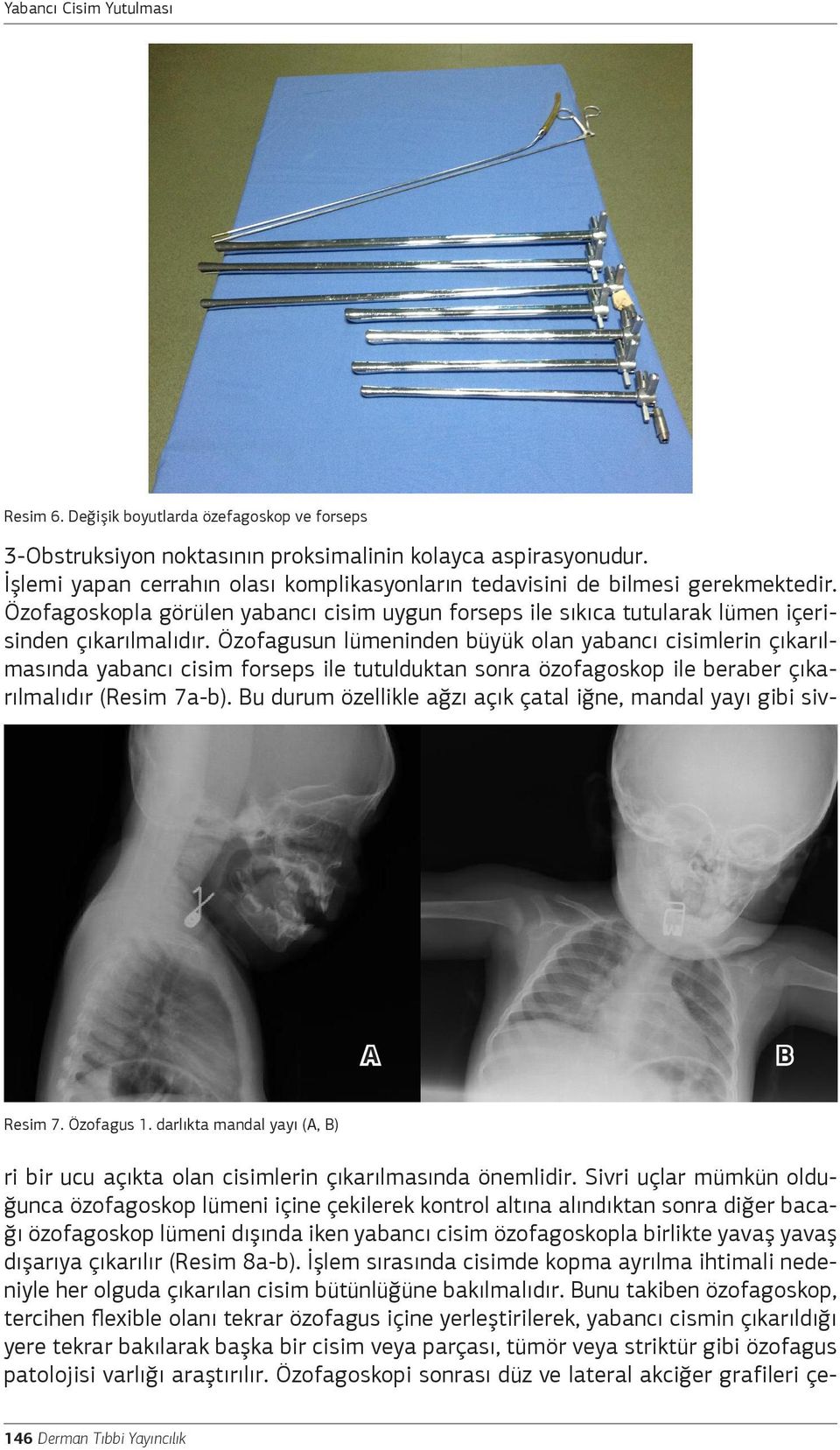 Özofagusun lümeninden büyük olan yabancı cisimlerin çıkarılmasında yabancı cisim forseps ile tutulduktan sonra özofagoskop ile beraber çıkarılmalıdır (Resim 7a-b).