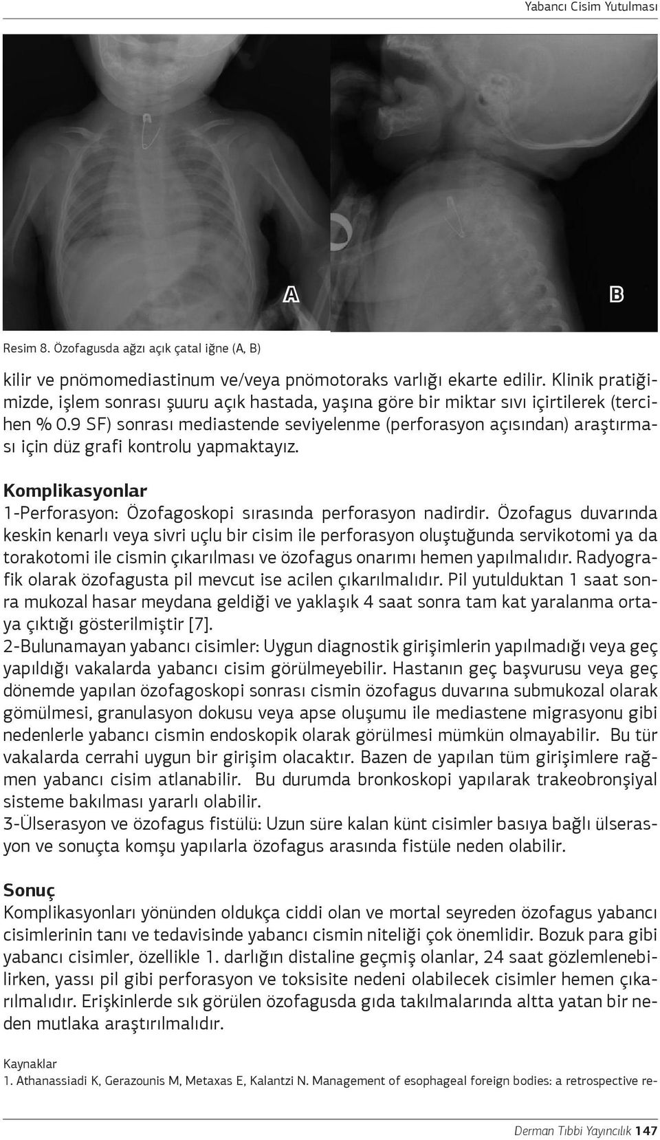 9 SF) sonrası mediastende seviyelenme (perforasyon açısından) araştırması için düz grafi kontrolu yapmaktayız. Komplikasyonlar 1-Perforasyon: Özofagoskopi sırasında perforasyon nadirdir.