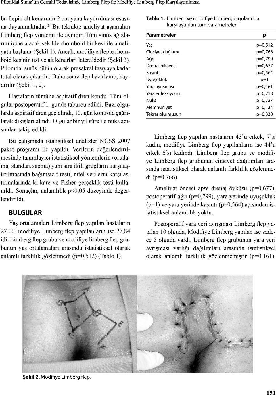 Ancak, modifiye flepte rhomboid kesinin üst ve alt kenarları lateraldedir (Şekil 2). Pilonidal sinüs bütün olarak presakral fasiyaya kadar total olarak çıkarılır.