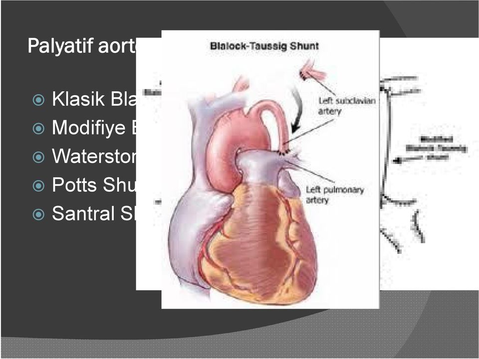 Blalock-Taussing Shunt Modifiye