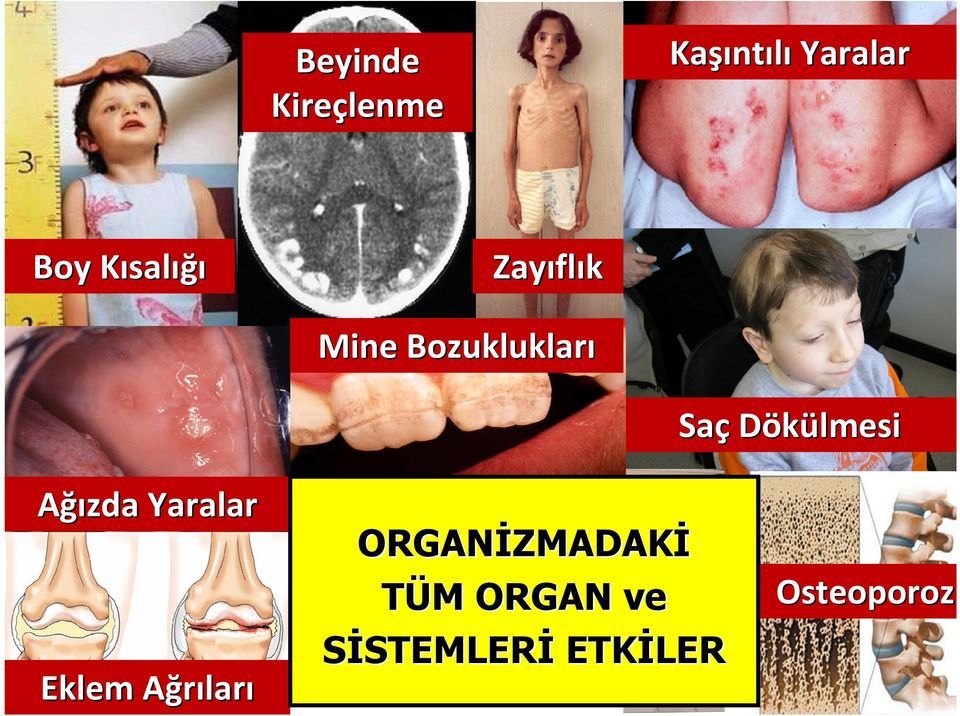 Dökülmesi Ağızda Yaralar ORGANİZMADAKİ TÜM