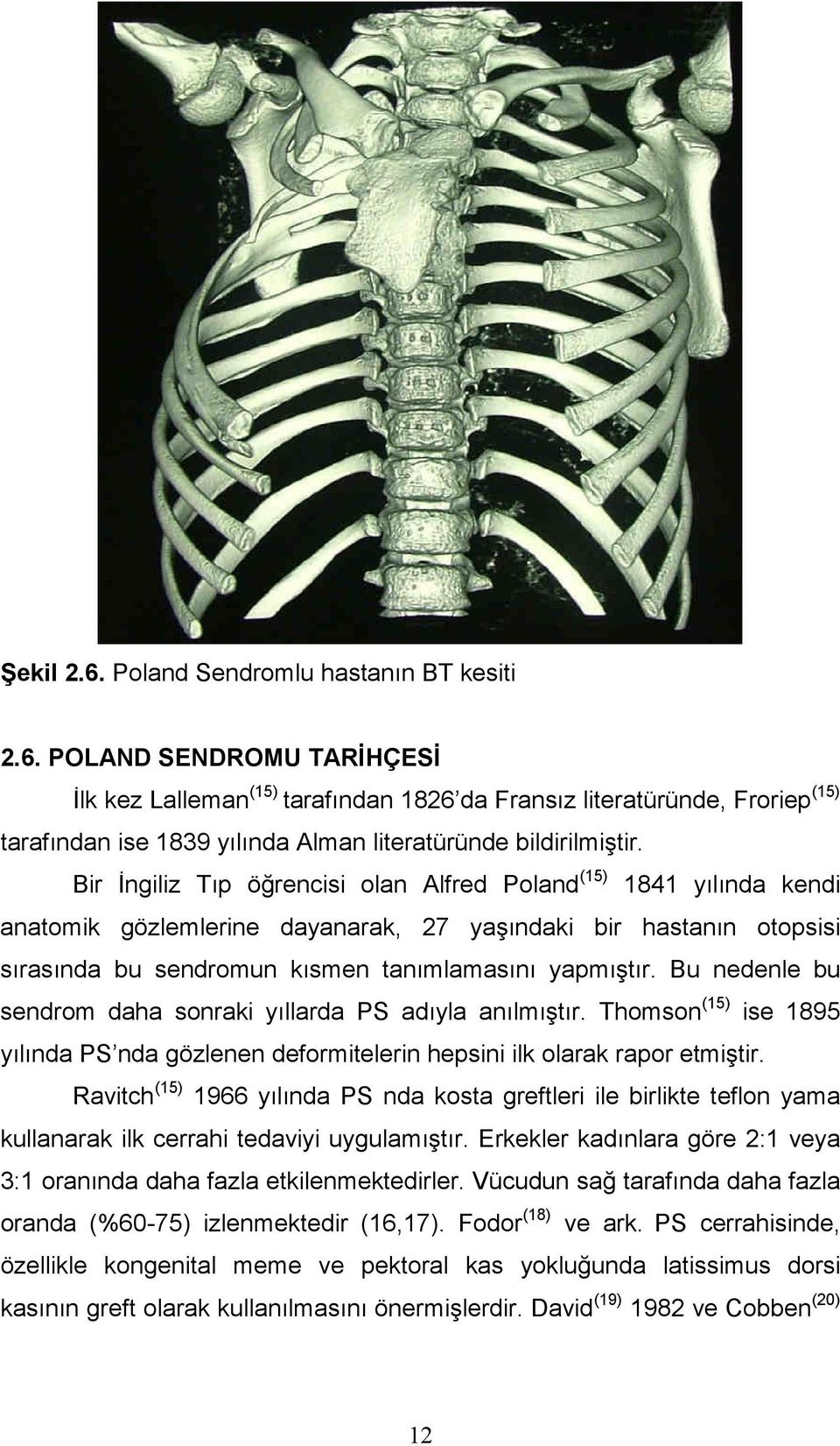 Bu nedenle bu sendrom daha sonraki yıllarda PS adıyla anılmıştır. Thomson (15) ise 1895 yılında PS nda gözlenen deformitelerin hepsini ilk olarak rapor etmiştir.