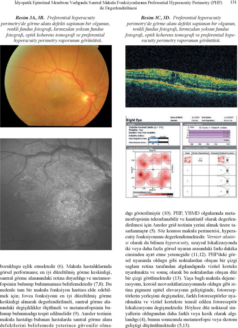 perimetry raporunun görüntüsü. Resim 3C, 3D.  perimetry raporunun görüntüsü. bozuklugu efllik etmektedir (6).