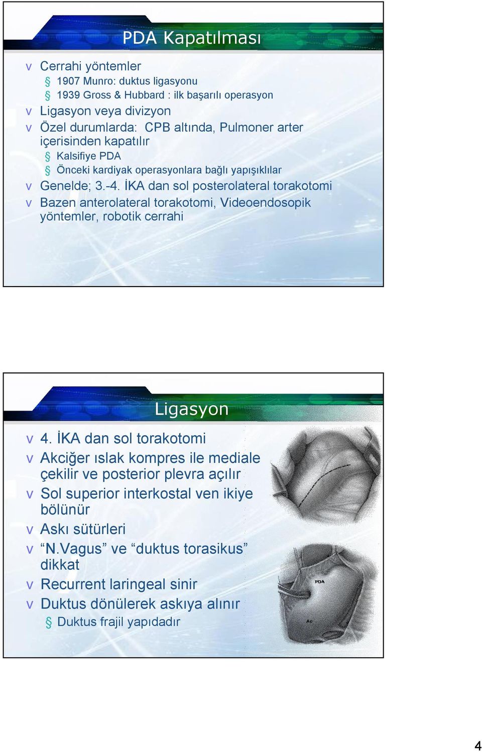 İKA dan sol posterolateral torakotomi v Bazen anterolateral torakotomi, Videoendosopik yöntemler, robotik cerrahi Ligasyon v4.