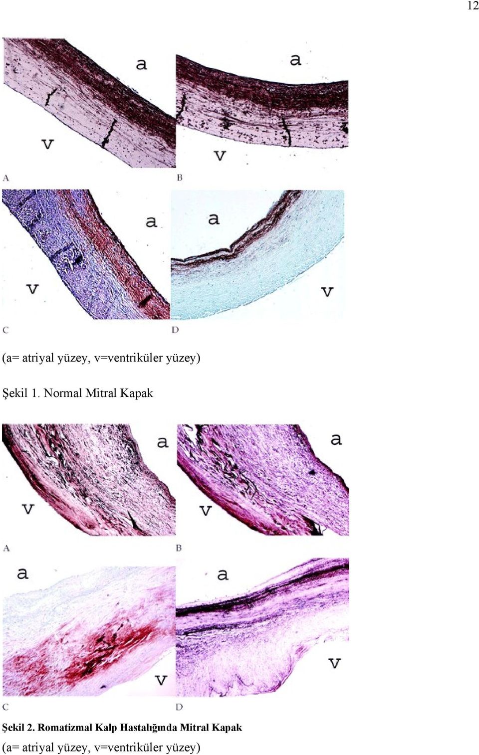 Normal Mitral Kapak Şekil 2.